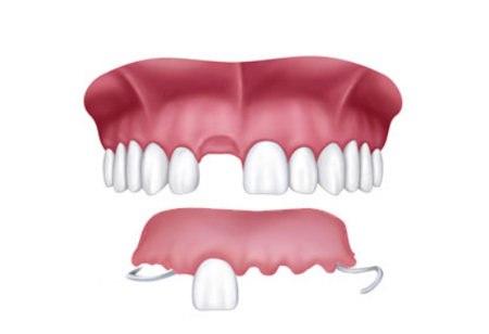 Prótesis Parcial Removible Dental Express®