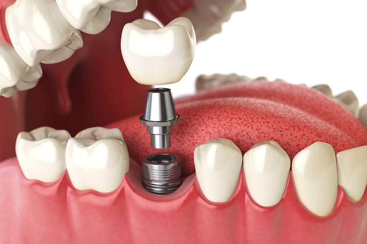 Reparaciones y Mantenimiento Dental Express® de Prótesis Implantadas - Image 3