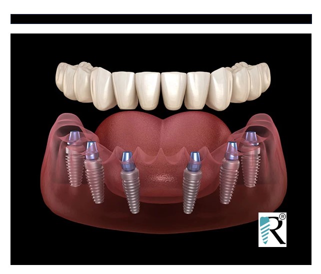 Reparaciones y Mantenimiento Dental Express® de Prótesis Implantadas