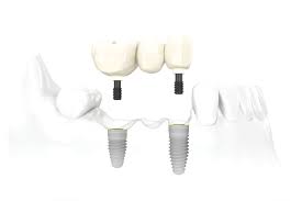Reparaciones y Mantenimiento Dental Express® de Prótesis Implantadas - Image 4