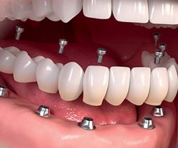 Reparaciones y Mantenimiento Dental Express® de Prótesis Implantadas - Image 2